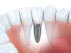 Dental Implant Cross Section View